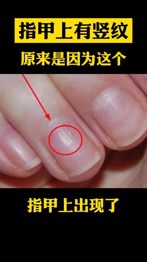 指甲有竖纹是什么原因的相关图片